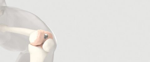 Analys, Episurf: Nytt kapital kan lyfta implantat